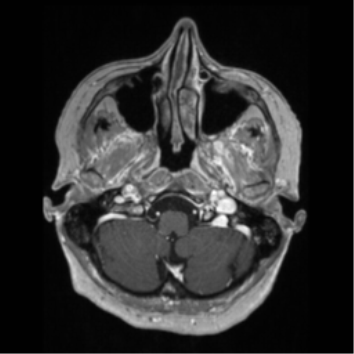 File:Anaplastic astrocytoma IDH wild-type (pseudoprogression) (Radiopaedia 42209-45276 Axial T1 C+ 28).png