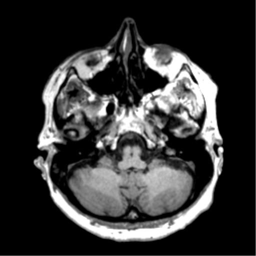 Anaplastic astrocytoma IDH wild-type (pseudoprogression) (Radiopaedia 42209-45277 Axial T1 26).png