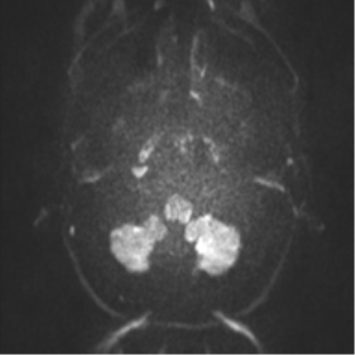 Anaplastic oligodendroglioma (Radiopaedia 37667-39563 Axial DWI 23).png