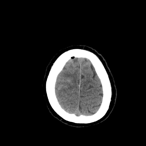 Aneursym related subarachnoid hemorrhage with hydrocephalus (Radiopaedia 45105-49085 Axial non-contrast 45).jpg