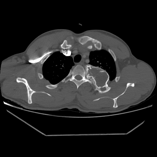 Aneurysmal bone cyst - rib (Radiopaedia 82167-96220 Axial bone window 70).jpg
