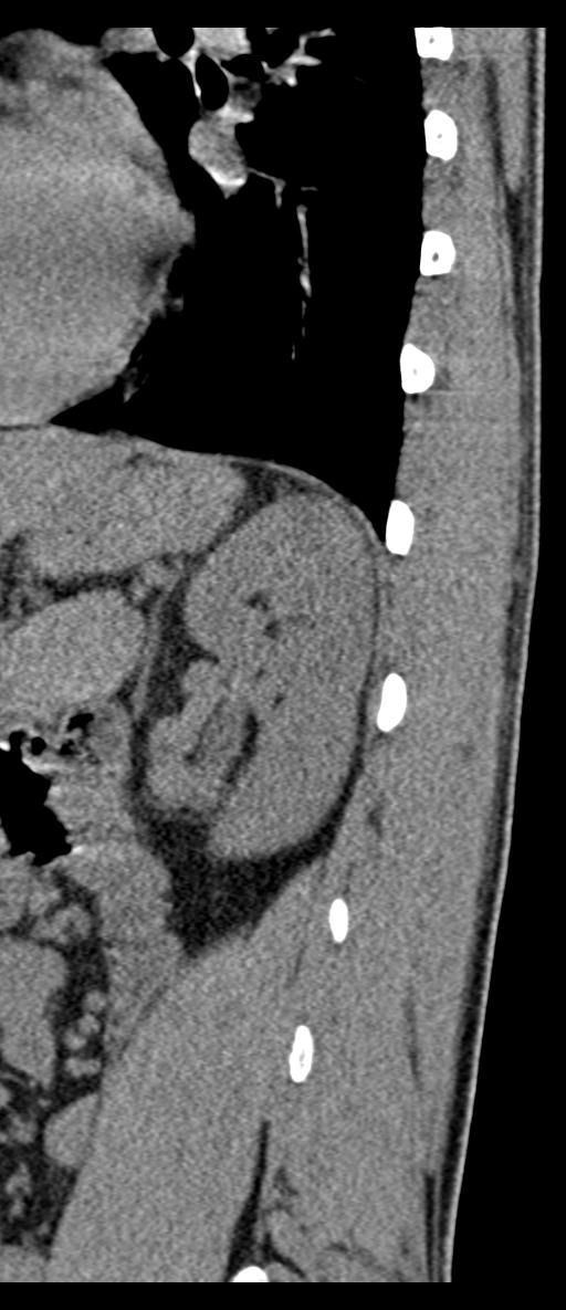 Aneurysmal bone cyst T11 (Radiopaedia 29294-29721 E 9).jpg