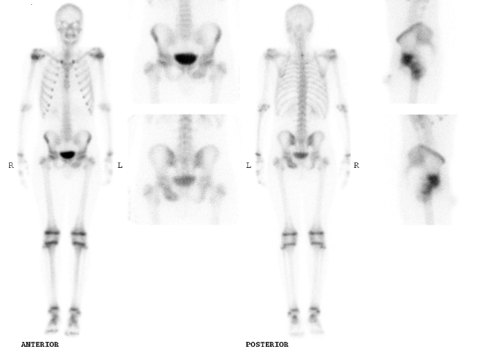 File:Aneurysmal bone cyst of ischium (Radiopaedia 25957-26095 A 1).png