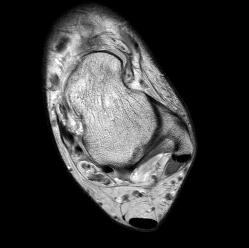 File:Aneurysmal bone cyst of the calcaneus (Radiopaedia 60669-68420 Axial PD 19).jpg