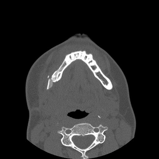 File:Aneurysmal bone cyst of the mandible (Radiopaedia 43280-46823 Axial bone window 37).jpg