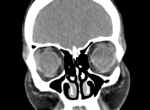 Angular dermoid cyst (Radiopaedia 88967-105790 Coronal non-contrast 22).jpg