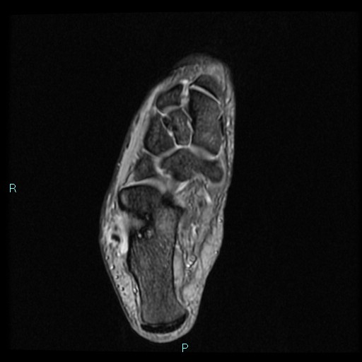 Ankle ganglion cyst (Radiopaedia 62809-71162 Axial Gradient Echo 29).jpg