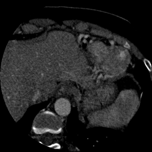 File:Anomalous left coronary artery from the pulmonary artery (ALCAPA) (Radiopaedia 40884-43586 A 82).jpg