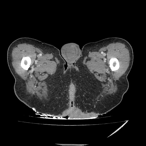 Anorectal carcinoma (Radiopaedia 44413-48064 A 68).jpg