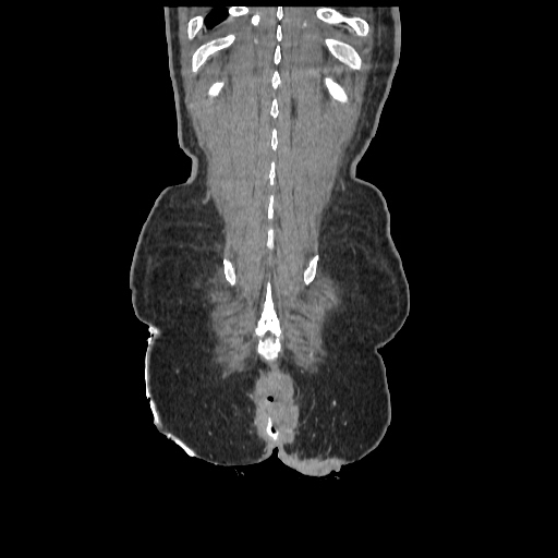 Anorectal carcinoma (Radiopaedia 44413-48064 B 85).jpg