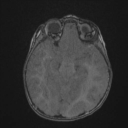 Anoxic brain injury (Radiopaedia 79165-92139 Axial MRA 99).jpg