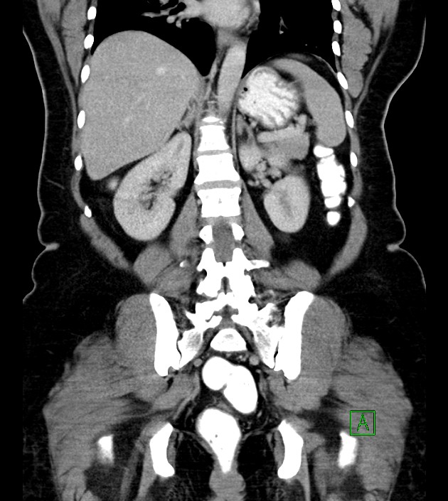 Anterior abdominal wall CSF pseudocyst (CSFoma) (Radiopaedia 79453-92571 B 38).jpg