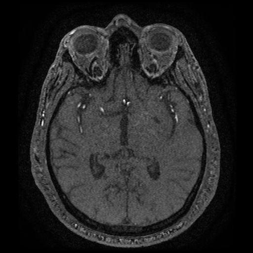 Anterior cerebral artery infarction (Radiopaedia 46794-51323 Axial MRA 97).jpg