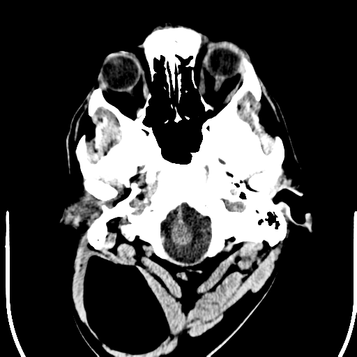 File:Anterior cerebral artery territory infarct (Radiopaedia 39327-41581 Axial non-contrast 2).png