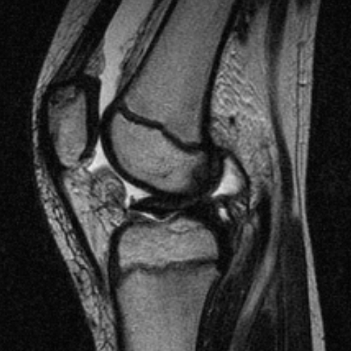 File:Anterior cruciate ligament avulsion fracture (Radiopaedia 24710-24974 Sagittal T2 9).jpg