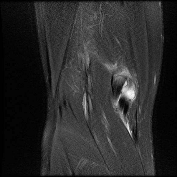 File:Anterior cruciate ligament graft tear and bucket-handle tear of medial meniscus (Radiopaedia 75867-87255 Coronal PD fat sat 23).jpg