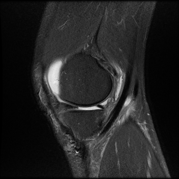 File:Anterior cruciate ligament graft tear and bucket-handle tear of medial meniscus (Radiopaedia 75867-87255 Sagittal PD fat sat 6).jpg