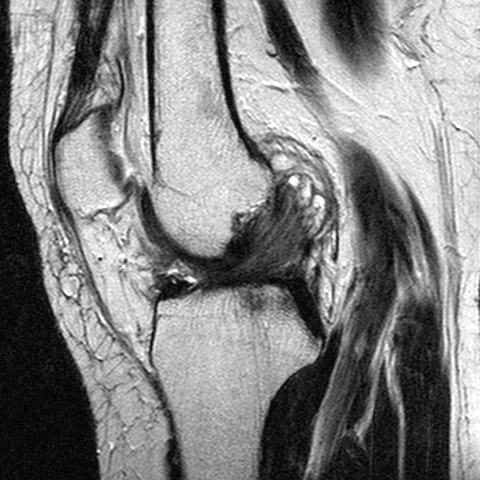 File:Anterior cruciate ligament mucoid degeneration (Radiopaedia 60853-68633 Sagittal T2 15).jpg