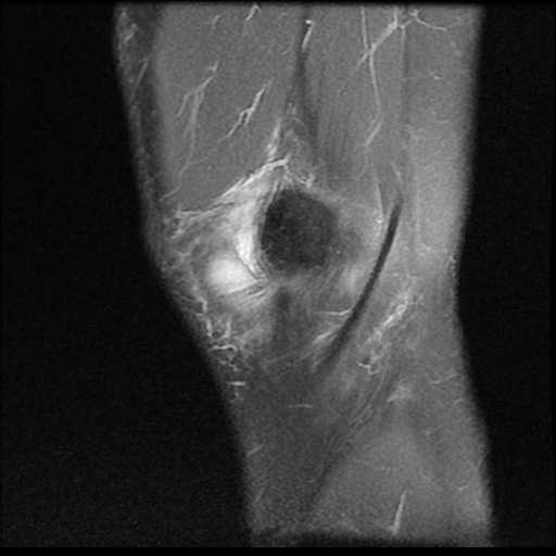 File:Anterior cruciate ligament tear (Radiopaedia 61500-69462 Sagittal PD fat sat 1).jpg