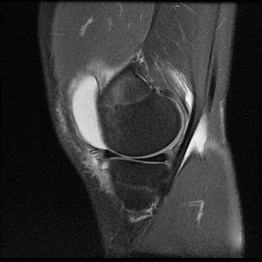 File:Anterior cruciate ligament tear (Radiopaedia 61500-69462 Sagittal PD fat sat 4).jpg