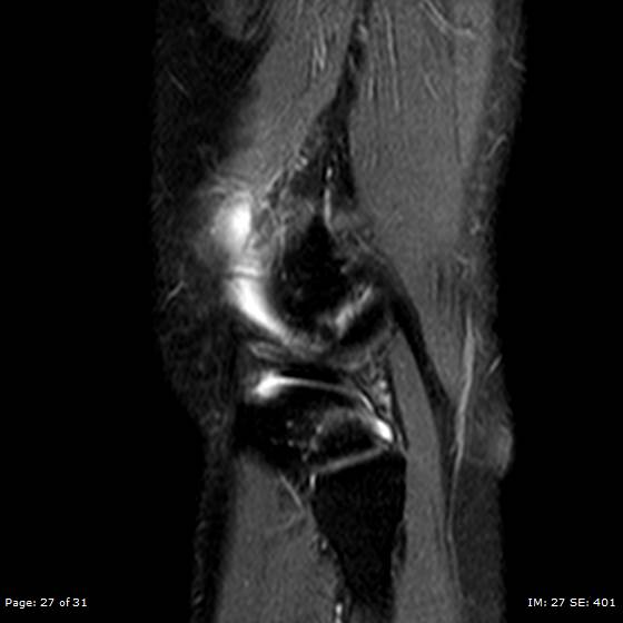 File:Anterior cruciate ligament tear (Radiopaedia 70783-80964 Sagittal STIR 27).jpg