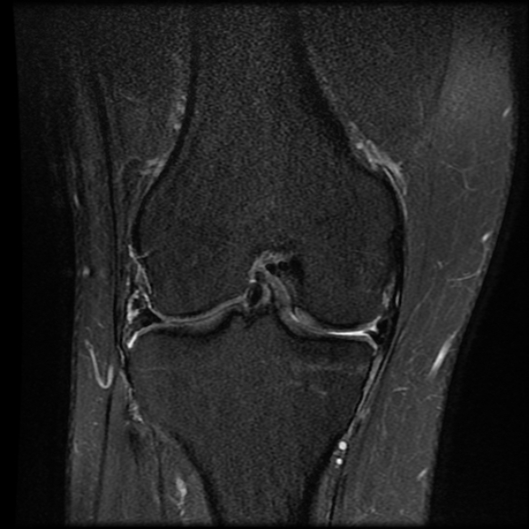 File:Anterior cruciate ligament tear with posteromedial corner injury, bucket-handle meniscal tear and chondral delamination (Radiopaedia 75501-86744 Coronal PD fat sat 15).jpg