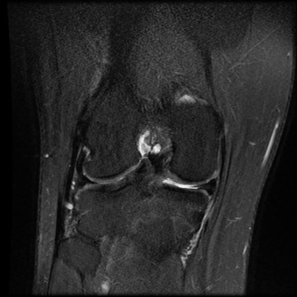 File:Anterior cruciate ligament tear with posteromedial corner injury, bucket-handle meniscal tear and chondral delamination (Radiopaedia 75501-86744 Coronal PD fat sat 17).jpg