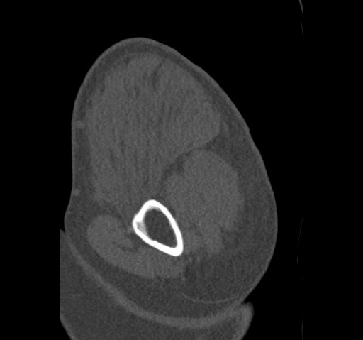 File:Anterior glenohumeral dislocation with Hill-Sachs lesion (Radiopaedia 62877-71249 Sagittal bone window 12).jpg