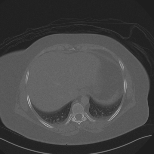 Anterior superior iliac spine avulsion fracture (Radiopaedia 44541-48244 Axial bone window 15).png