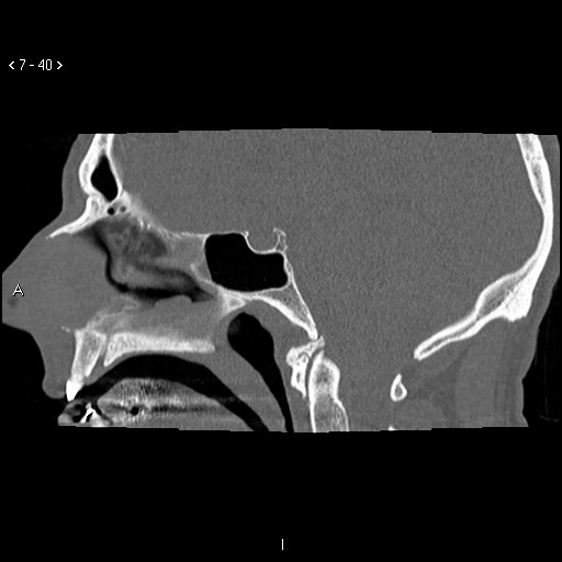 File:Antrochoanal Polyp (Radiopaedia 70510-80631 Sagittal bone window 30).jpg