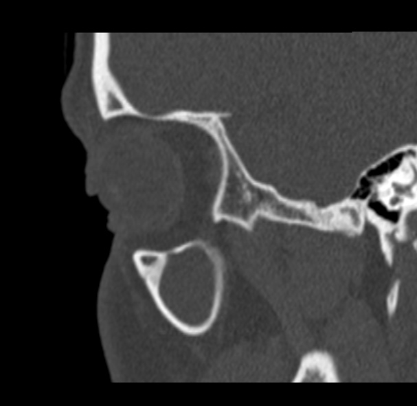 File:Antrochoanal polyp (Radiopaedia 33984-35202 Sagittal bone window 10).jpg
