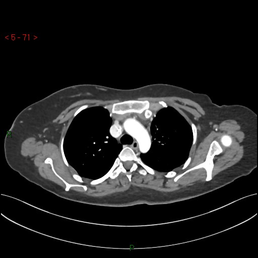 File:Aortic arch origin of left vertebral artery (Radiopaedia 51520-57286 A 70).jpg