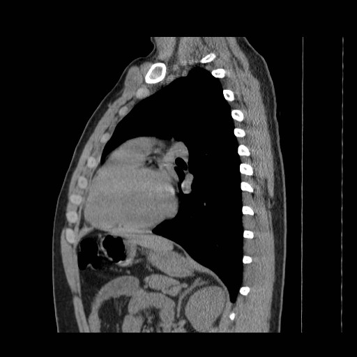 File:Aortic arch stent (Radiopaedia 30030-30595 B 22).jpg