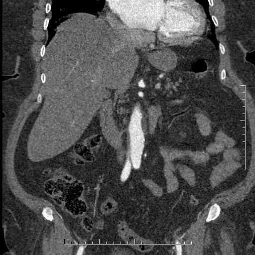 File:Aortic dissection- Stanford A (Radiopaedia 35729-37268 F 39).jpg