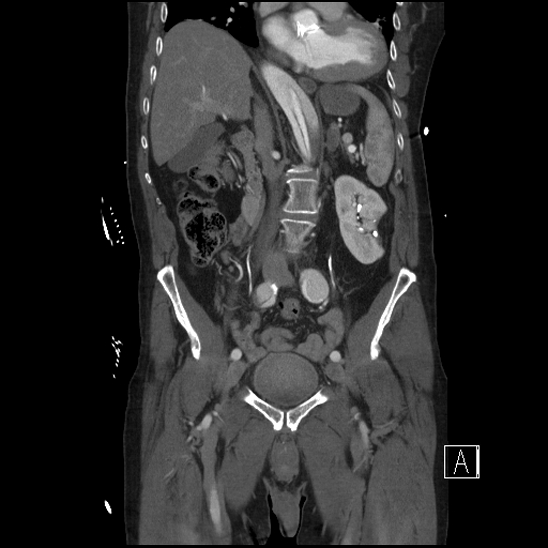 File:Aortic dissection (CTPA) (Radiopaedia 75506-86750 F 33).jpg