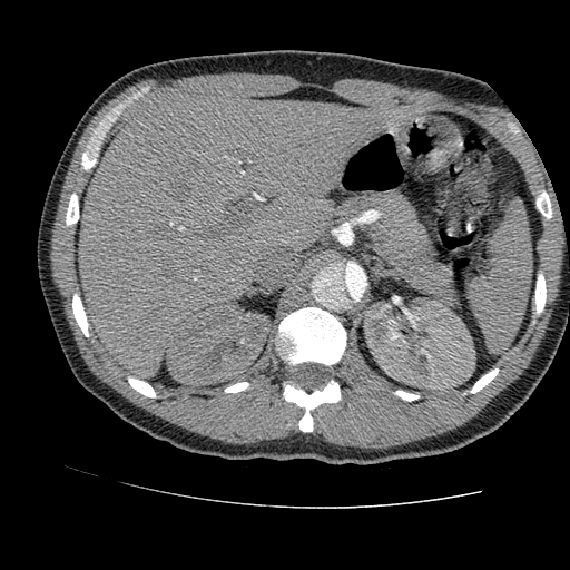 File:Aortic dissection - Stanford A -DeBakey I (Radiopaedia 28339-28587 B 111).jpg
