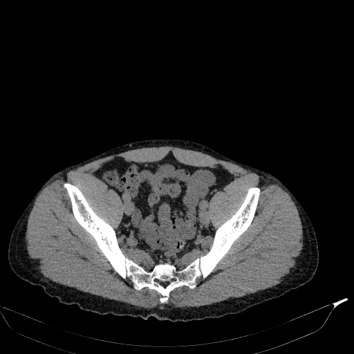 Aortic dissection - Stanford type A (Radiopaedia 83418-98500 Axial non-contrast 81).jpg