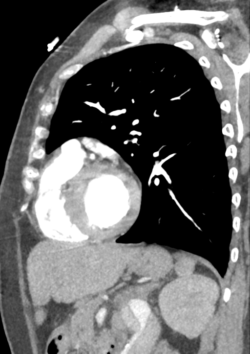 Aortic dissection - Stanford type B (Radiopaedia 50171-55512 C 14).png