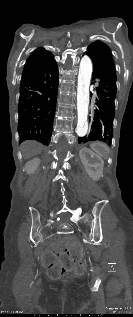 Aortic dissection with extension into aortic arch branches (Radiopaedia 64402-73204 A 61).jpg