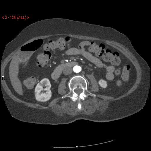 Aortic intramural hematoma (Radiopaedia 27746-28001 A 120).jpg