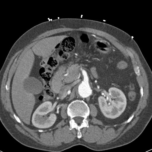 File:Aortic intramural hematoma (Radiopaedia 31139-31838 B 96).jpg