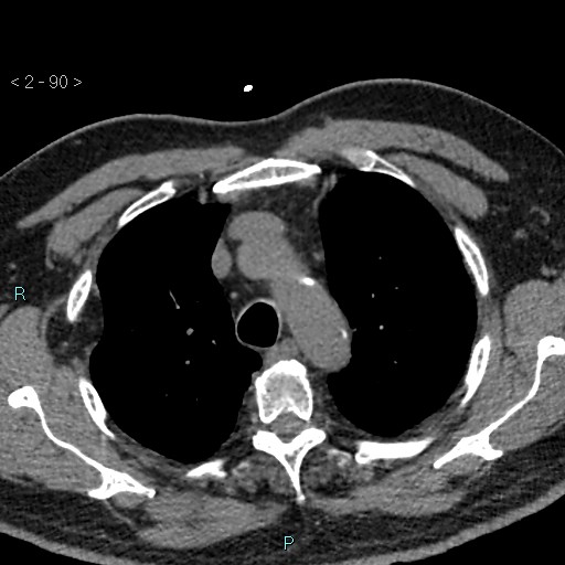 Aortic intramural hematoma (Radiopaedia 48463-53380 Axial non-contrast 40).jpg