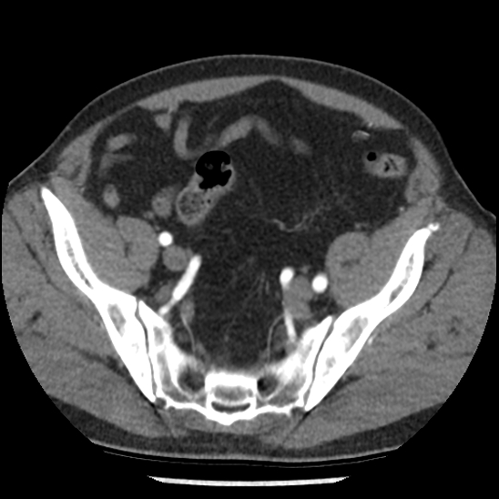 File:Aortic intramural hematoma (type B) (Radiopaedia 79323-92387 B 98).jpg