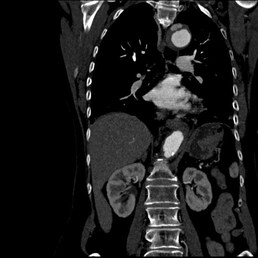 Aortic intramural hematoma from penetrating atherosclerotic ulcer (Radiopaedia 31137-31836 C 39).jpg