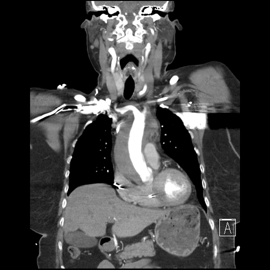 Aortic intramural hematoma with dissection and intramural blood pool (Radiopaedia 77373-89491 C 20).jpg