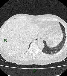 File:Aortic valve endocarditis (Radiopaedia 87209-103485 Axial lung window 84).jpg