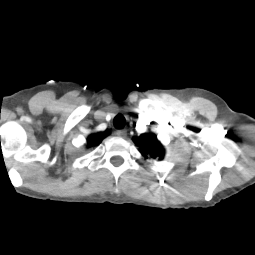 Aortic valve non-coronary cusp thrombus (Radiopaedia 55661-62189 B 5).png