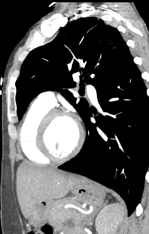 Aortic valve non-coronary cusp thrombus (Radiopaedia 55661-62189 C+ arterial phase 18).png