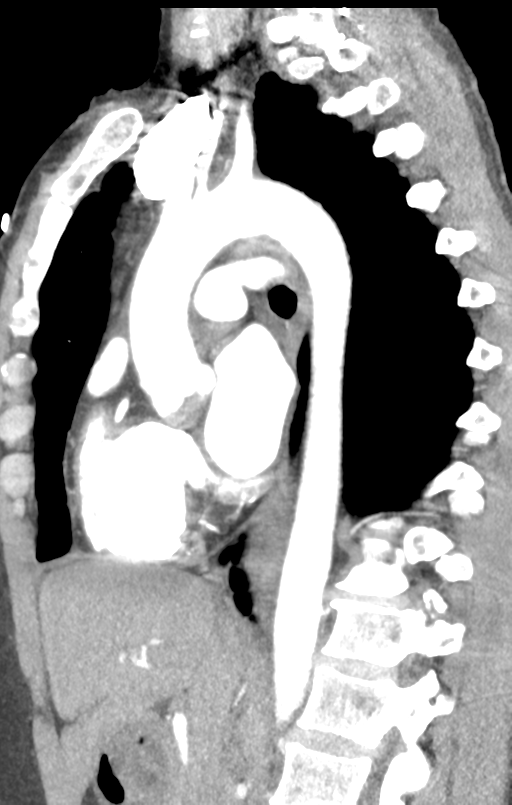 Aortic valve non-coronary cusp thrombus (Radiopaedia 55661-62189 C+ arterial phase 28).png