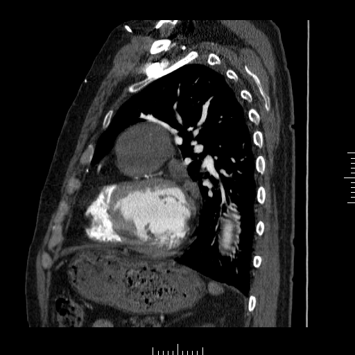 File:Aorto-coronary bypass graft aneurysms (Radiopaedia 40562-43157 C 30).png